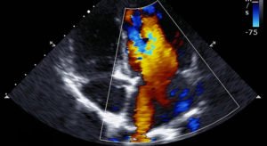 Echocardiagram sample-CrouseHealth